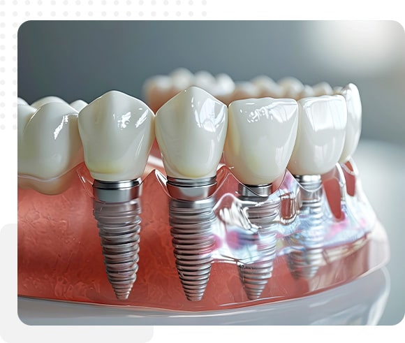 Dental implant model showing the implant in the gum and bone